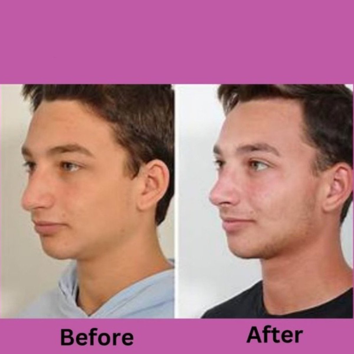 Before and after ultrasonic rhinoplasty results at ID Clinic Bangkok, improved nose profile