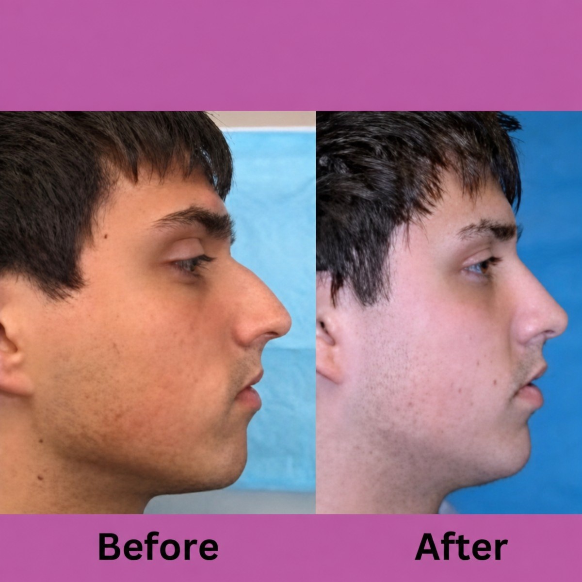 Before and after ultrasonic rhinoplasty results at ID Clinic Bangkok, improved nose profile