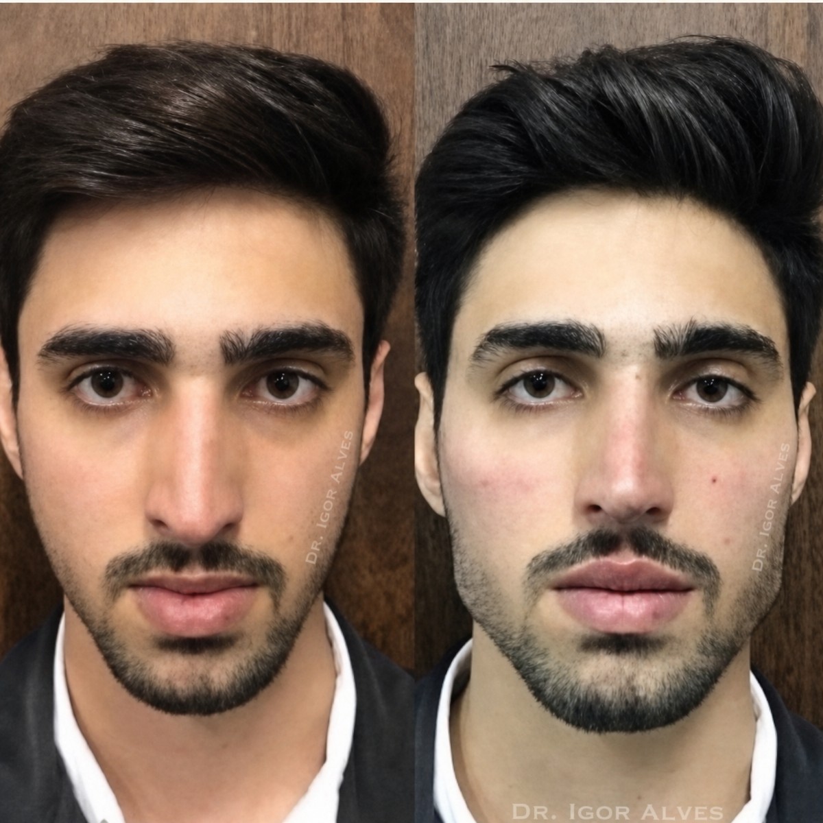 Before and after rhinoplasty results at ID Clinic Bangkok, improved nose shape and symmetry