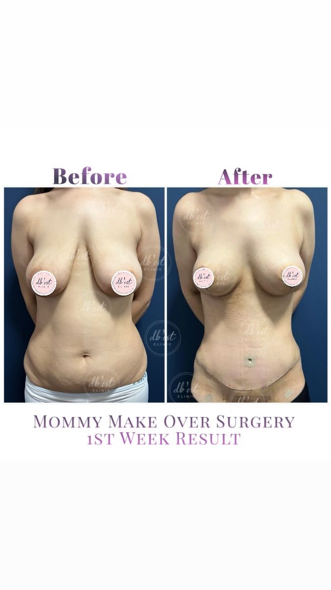 Vorher-nachher Mommy Makeover bei Db'est Clinic, 1. Wochenresultat, Körperkontur