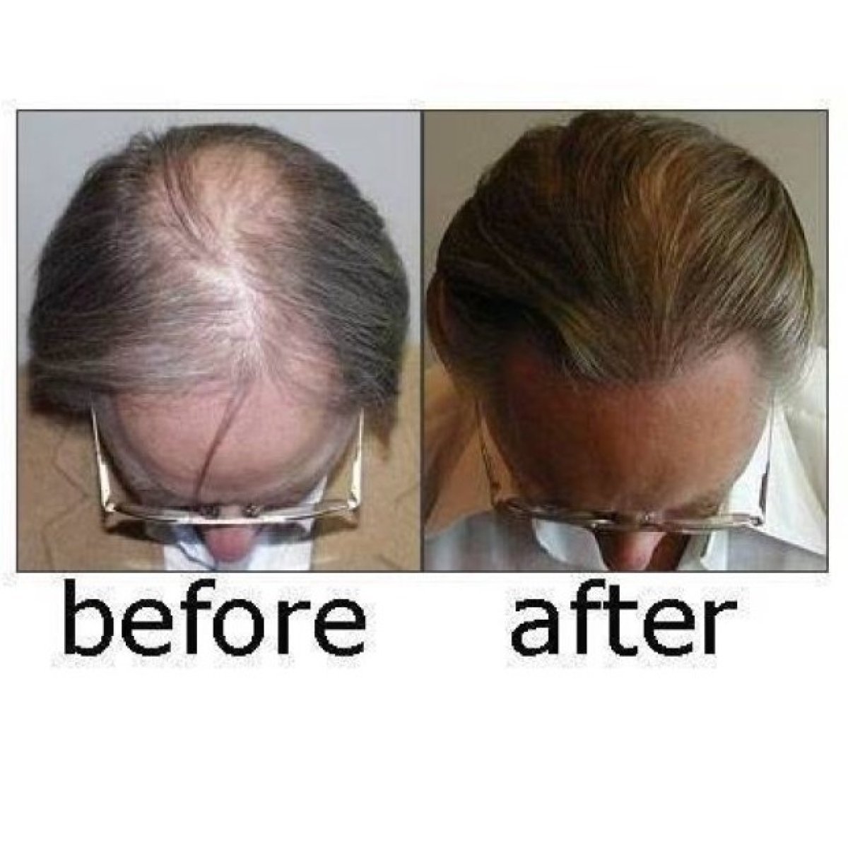Before and after DHI hair transplant results at ID Clinic Bangkok, restored hair density