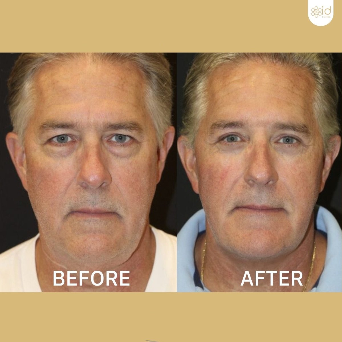 Before and after brow lift results at ID Clinic Bangkok, visible forehead and eye area rejuvenation
