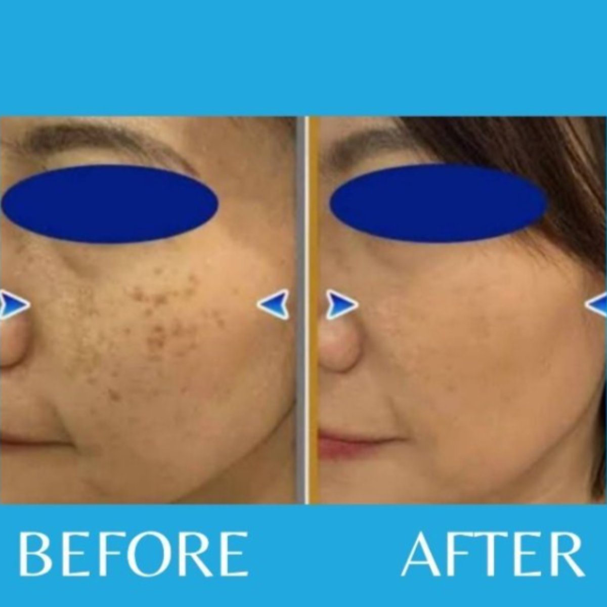 Before and after skin rejuvenation at ID Clinic Bangkok, improved facial pigmentation result