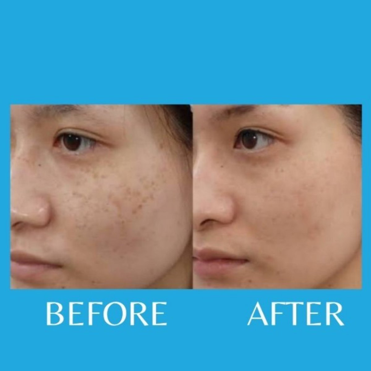 Avant et après rajeunissement de la peau à ID Clinic Bangkok, texture cutanée améliorée