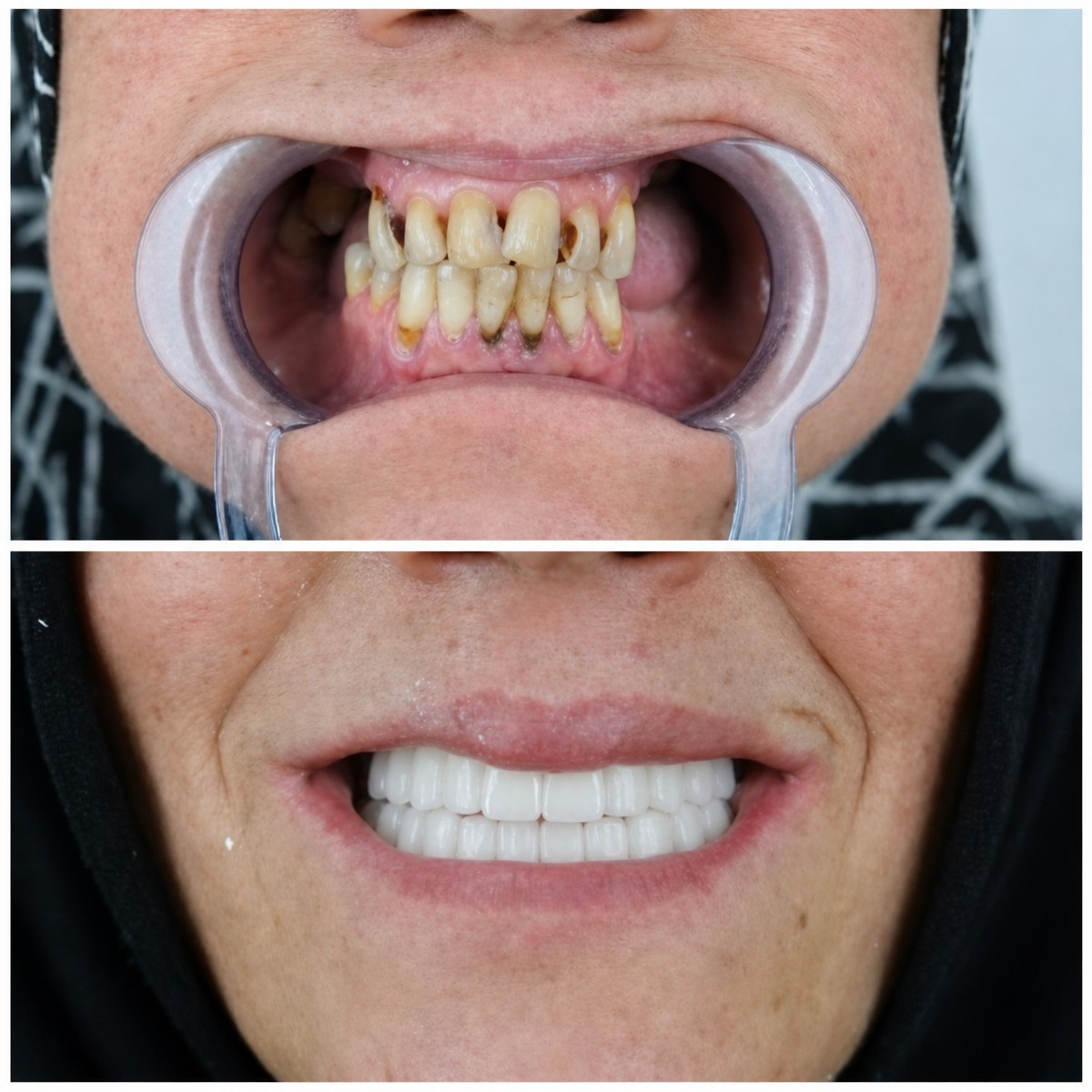 نتائج قبل وبعد زراعة الأسنان في YEG Clinic – ابتسامة وأسنان صحية مستعادة