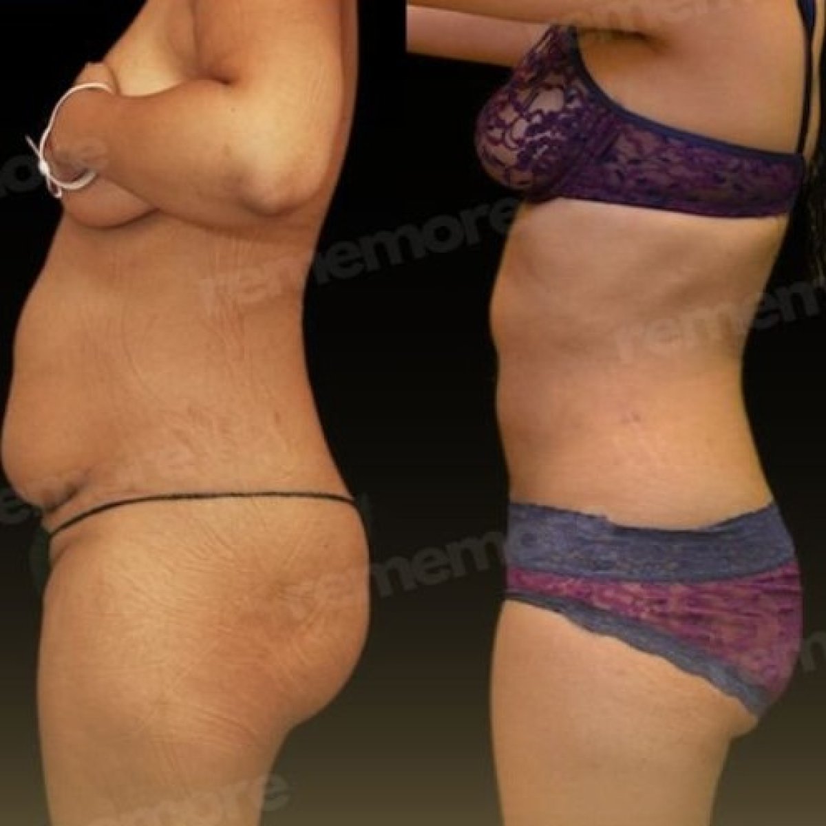 Before and after Vaser liposuction results at Memorial Şişli Hospital, improved body contour
