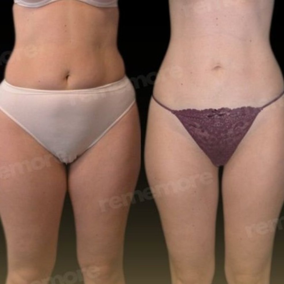 Before and after Vaser liposuction results at Memorial Şişli Hospital, improved body contour