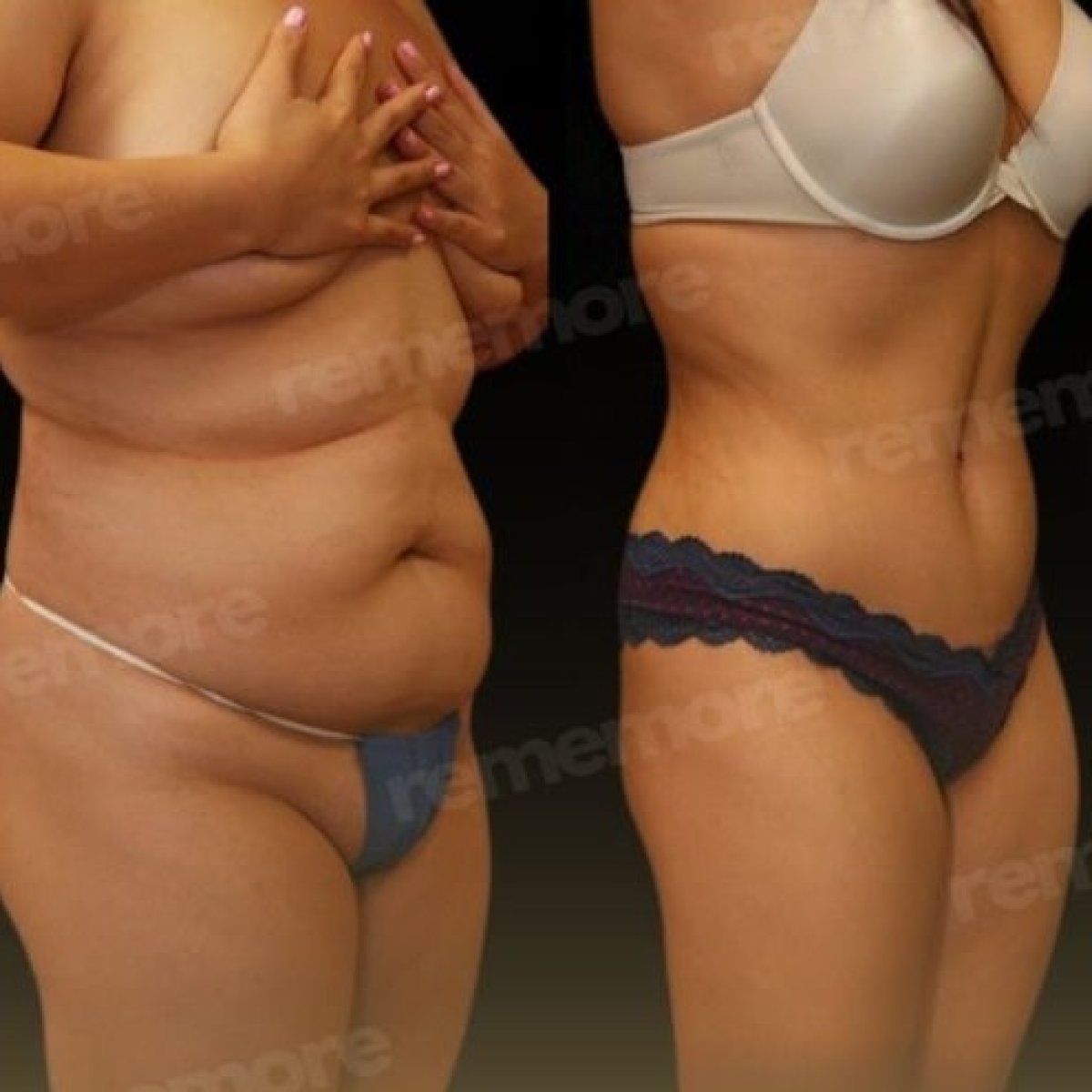 Before and after Vaser liposuction results at Memorial Şişli Hospital, body contour improvement