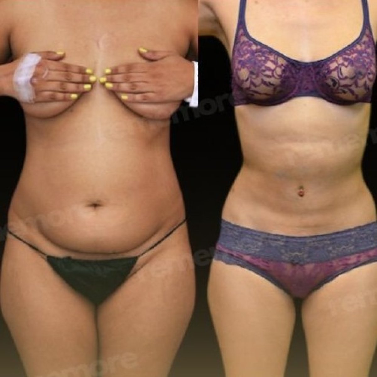 Before and after Vaser liposuction results at Memorial Şişli Hospital, improved body contour