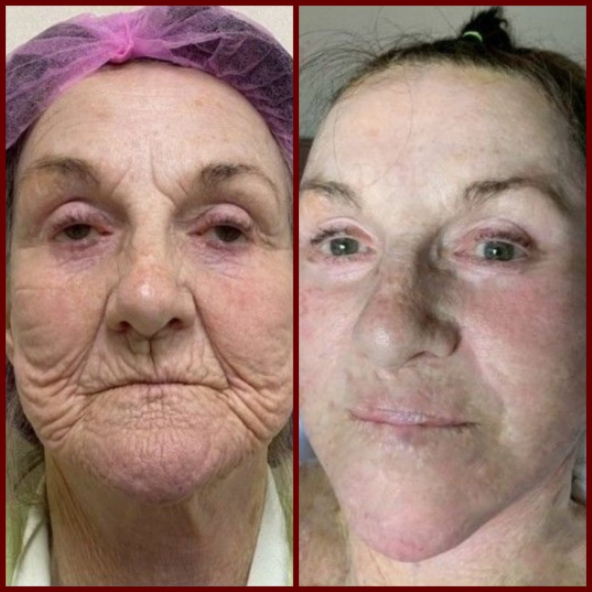 Resultados de lifting facial antes y después en DGB Clinic: menos arrugas y piel firme