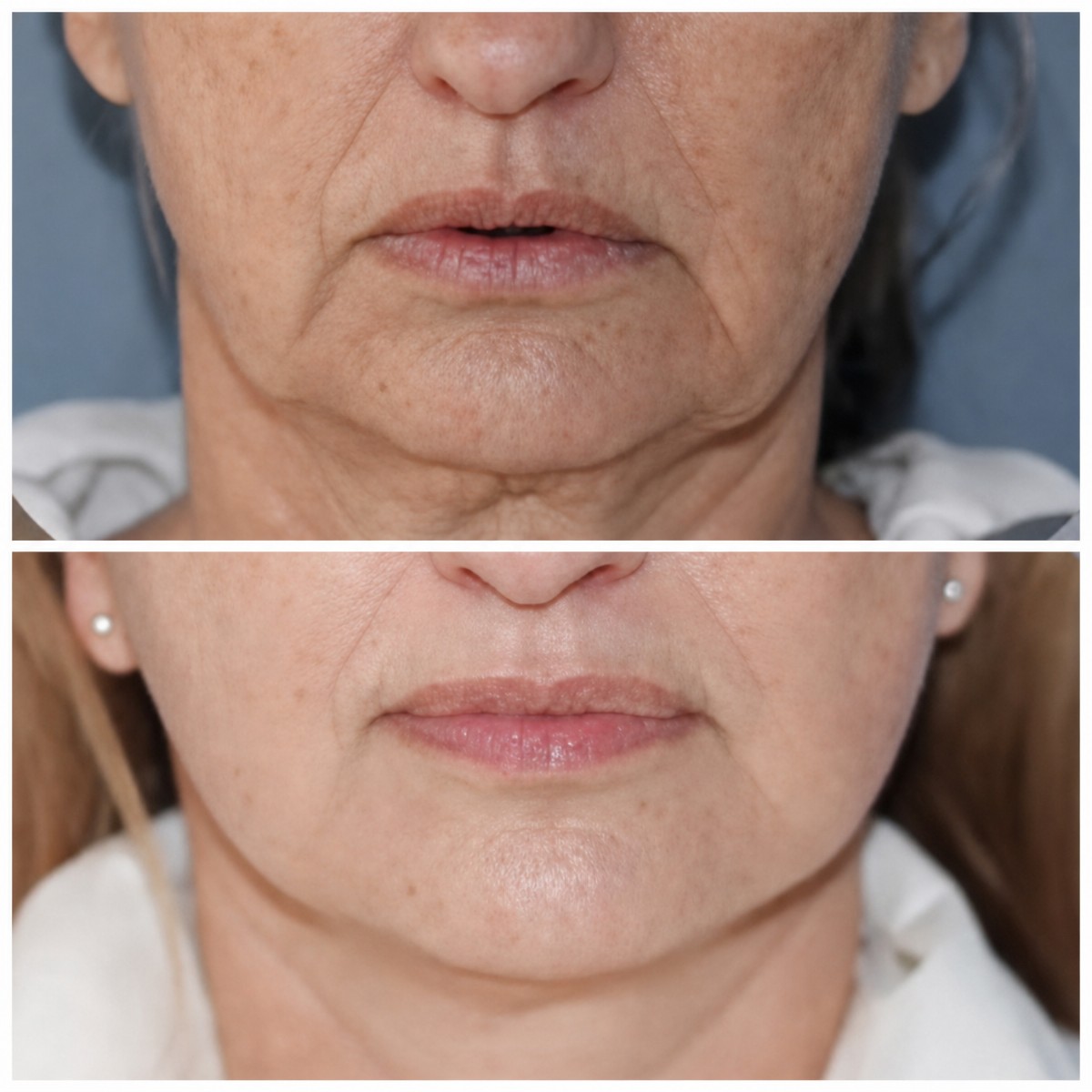 Résultats avant/après lifting du visage à Klinika Promedion – rajeunissement visible