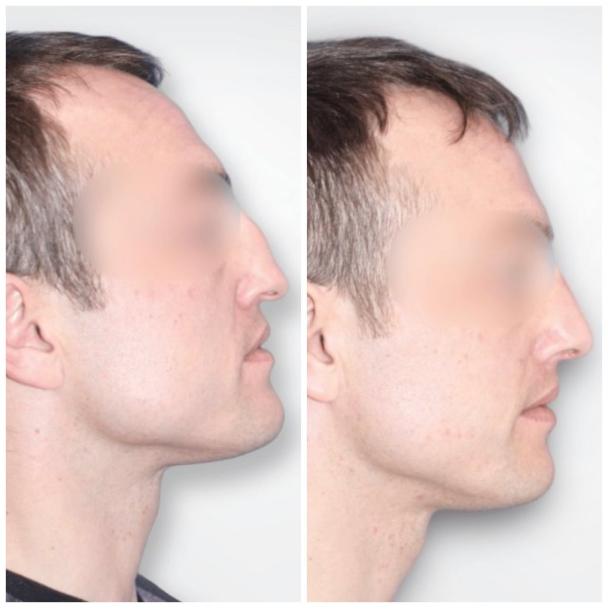 Before and after rhinoplasty results at Klinika Promedion, improved male nose profile