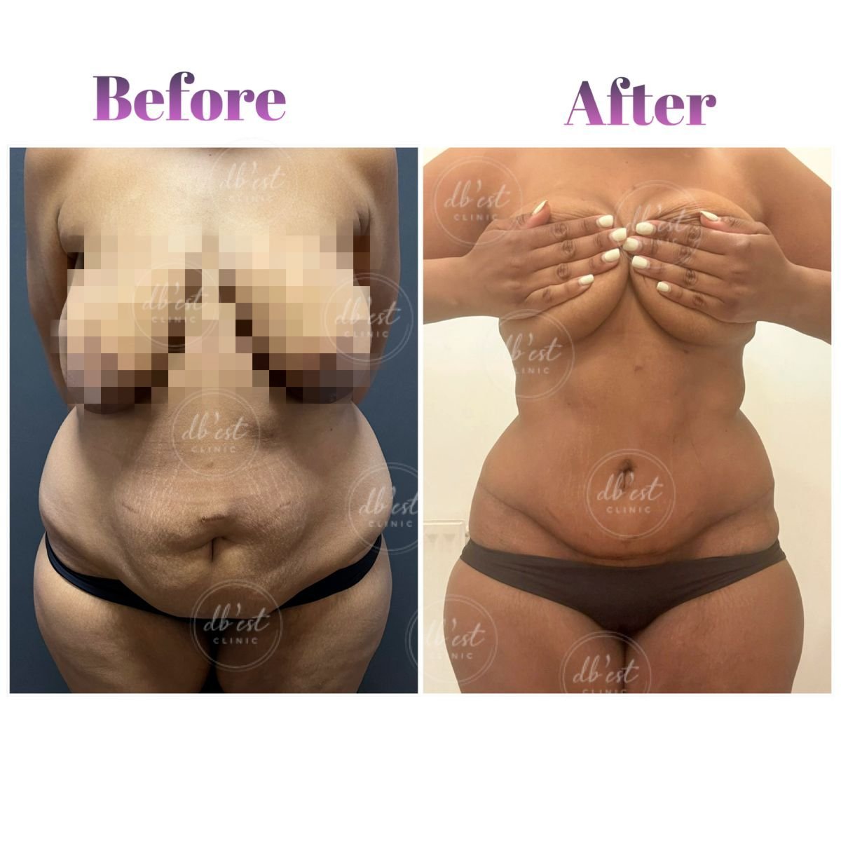 Resultados de abdominoplastia antes y después en Db'est Clinic – abdomen mejorado