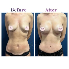 Tummy Tuck with Liposuction by European Board Certified Surgeon — All Included - photo 5