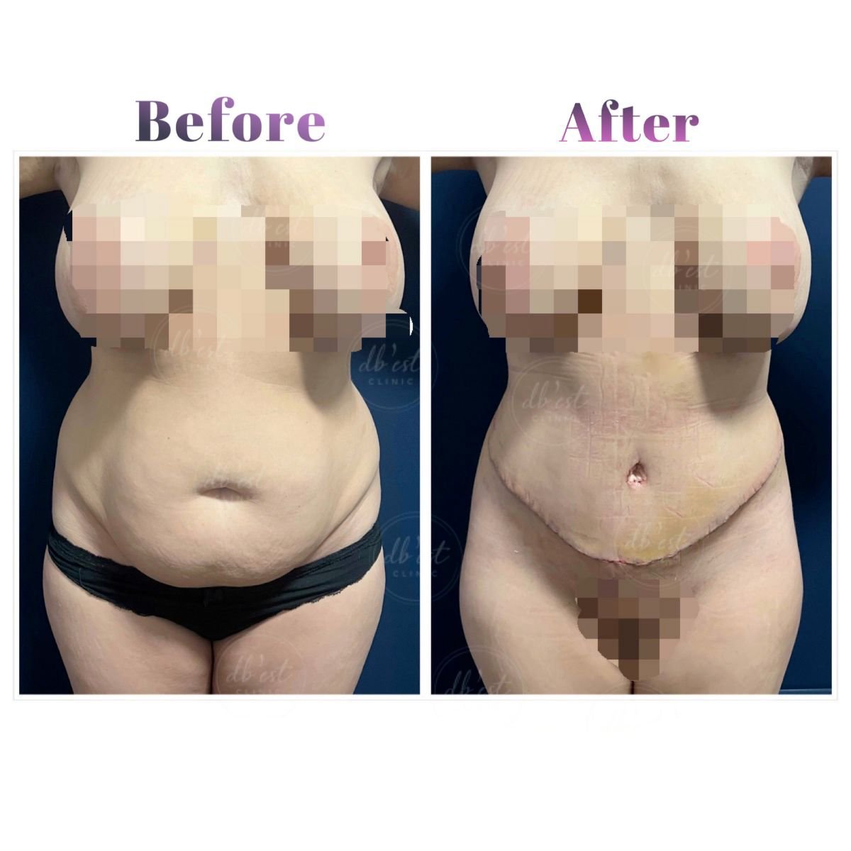 Resultados de abdominoplastia antes y después en Db'est Clinic – mejora del contorno abdominal