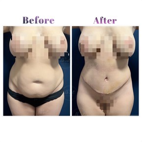 Tummy Tuck with Liposuction by European Board Certified Surgeon — All Included - photo 4