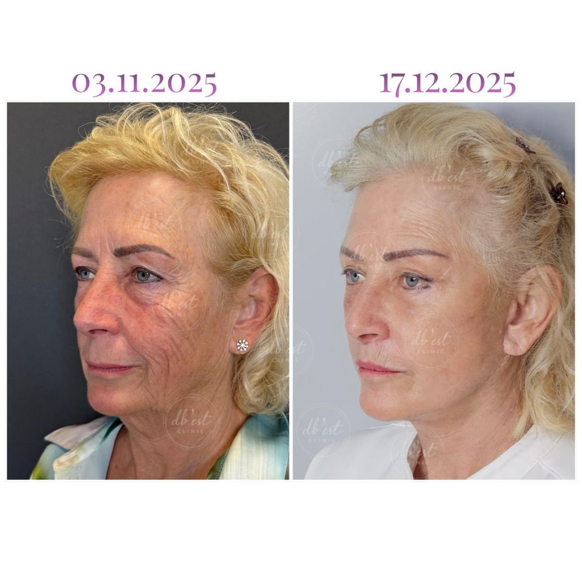 Результати до і після Deep Plane Facelift у Db'est Clinic – помітне омолодження обличчя