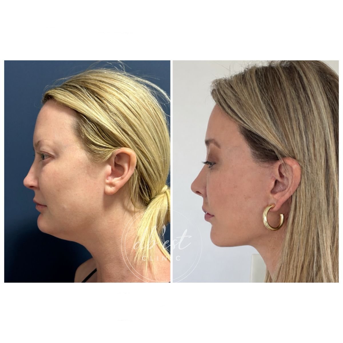 Résultat avant/après Deep Plane Facelift à Db'est Clinic – lifting visible du cou et de la mâchoire