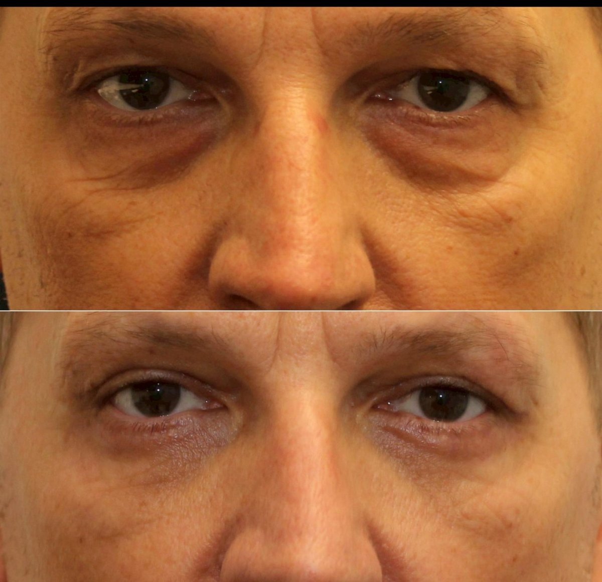 Before and after blepharoplasty results at Somchai Clinic, reduced eyelid bags and wrinkles
