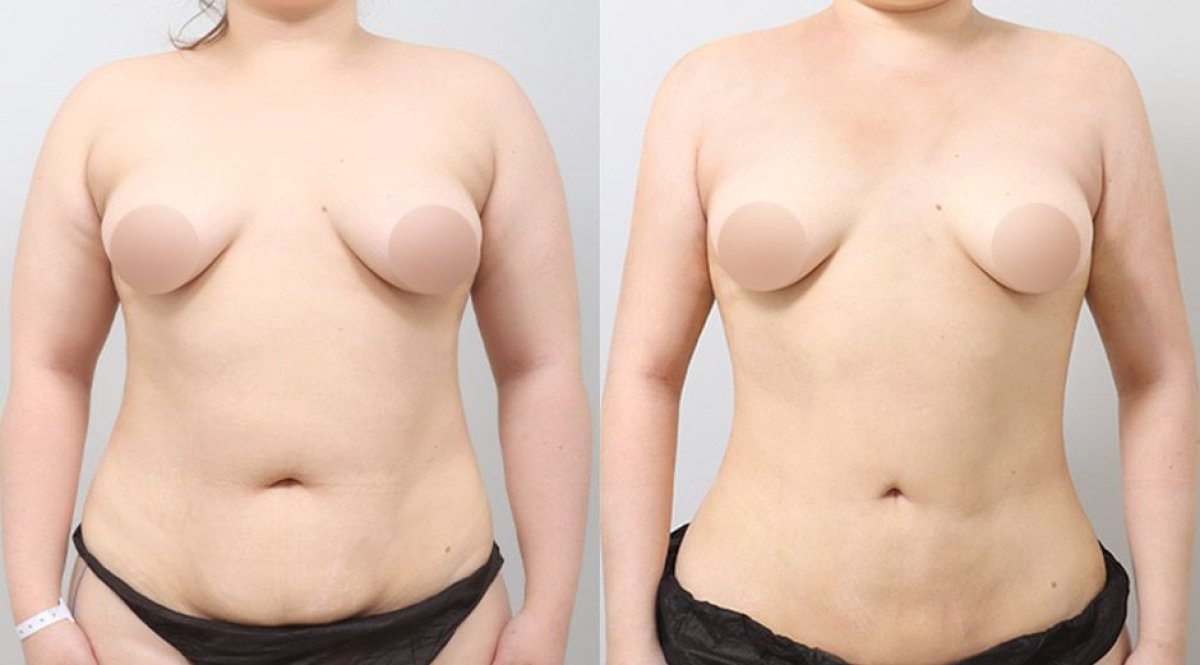 نتائج شفط دهون البطن قبل وبعد في AB Plastic Surgery – خصر أنحف