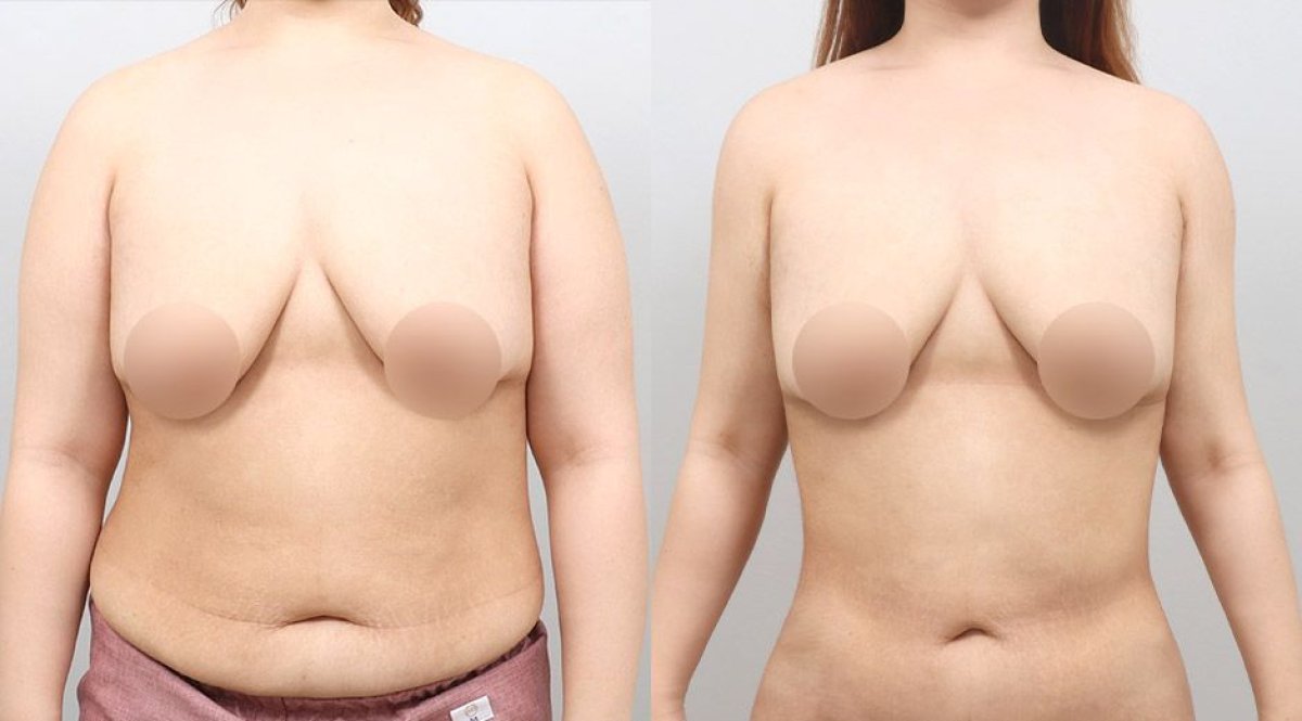 Before and after abdominal liposuction results at AB Plastic Surgery, slimmer waist contour
