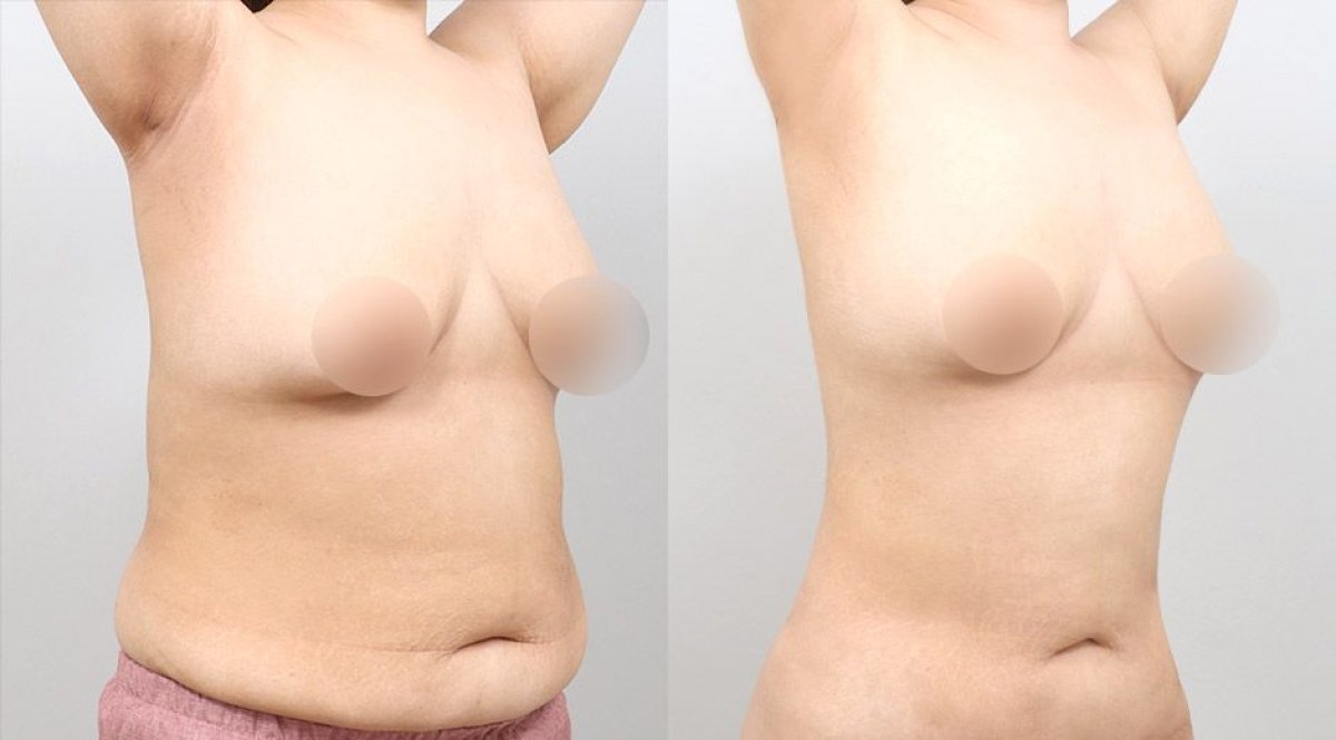 Résultats avant et après liposuccion abdominale chez AB Plastic Surgery – taille affinée