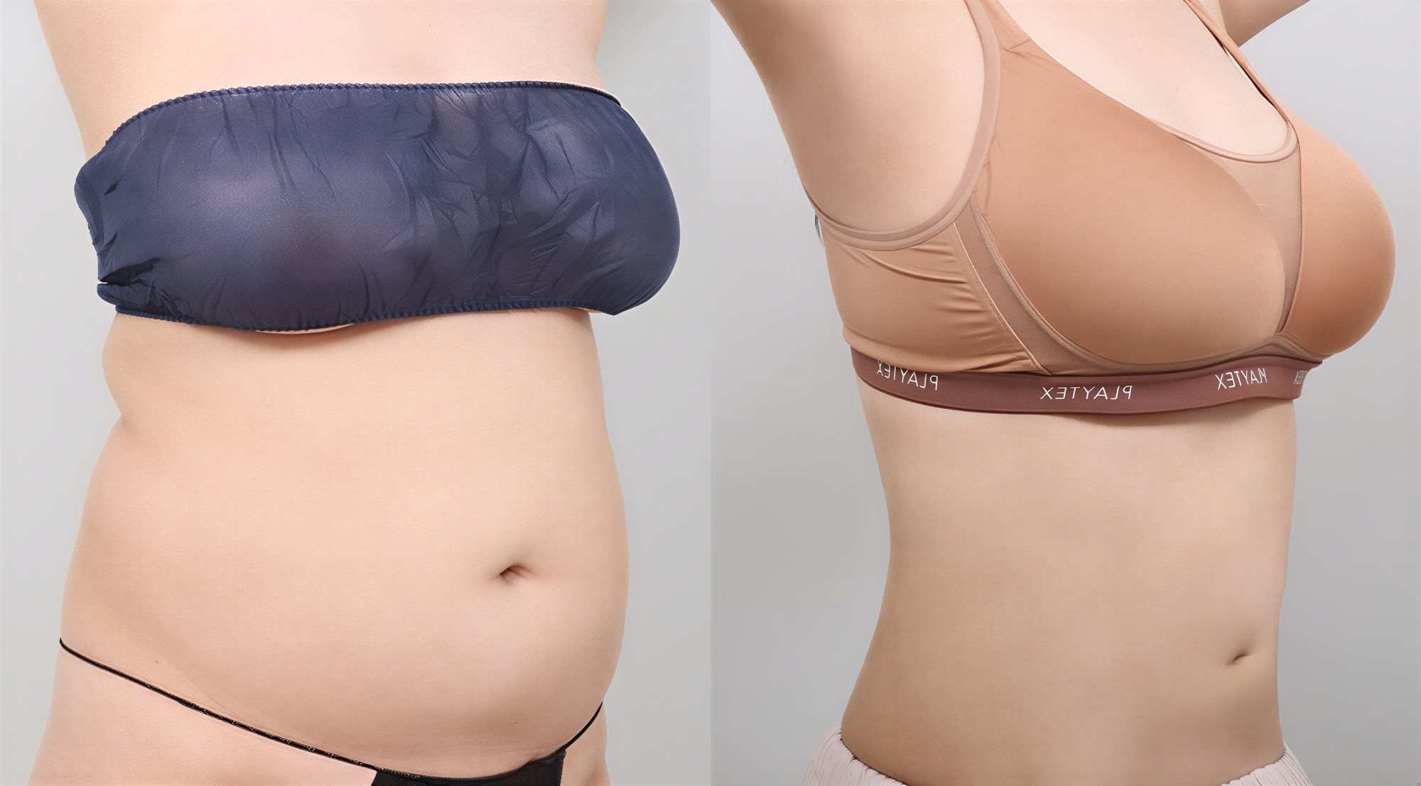 Resultados de liposucción abdominal antes y después en AB Plastic Surgery – cintura más delgada