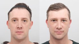 Fotos vor und nach Facelift durch Dr. Inho Bae