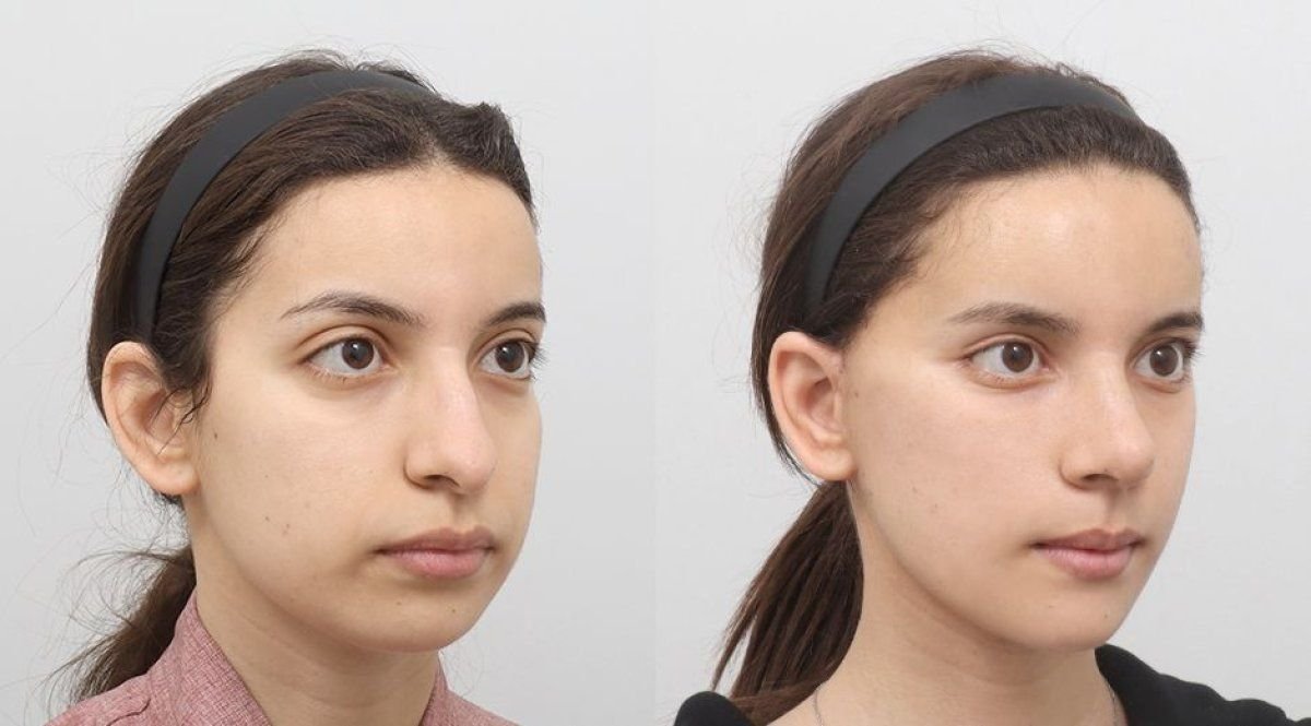 Facelift before and after results at AB Plastic Surgery – visible facial rejuvenation outcome