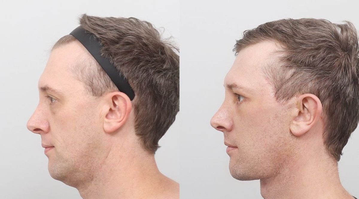Результати до та після фейсліфтингу в AB Plastic Surgery, покращення контуру обличчя