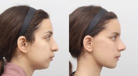 Fotos vor und nach Facelift durch Dr. Inho Bae