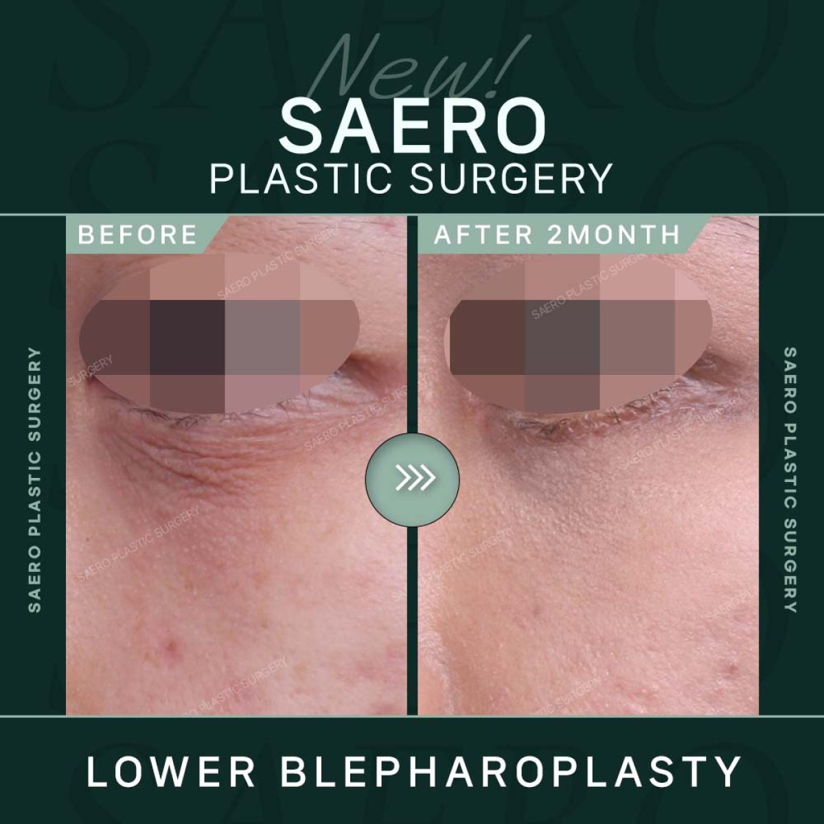 نتائج رأب الجفن السفلي قبل وبعد في SAERO Plastic Surgery بعد شهرين من الجراحة