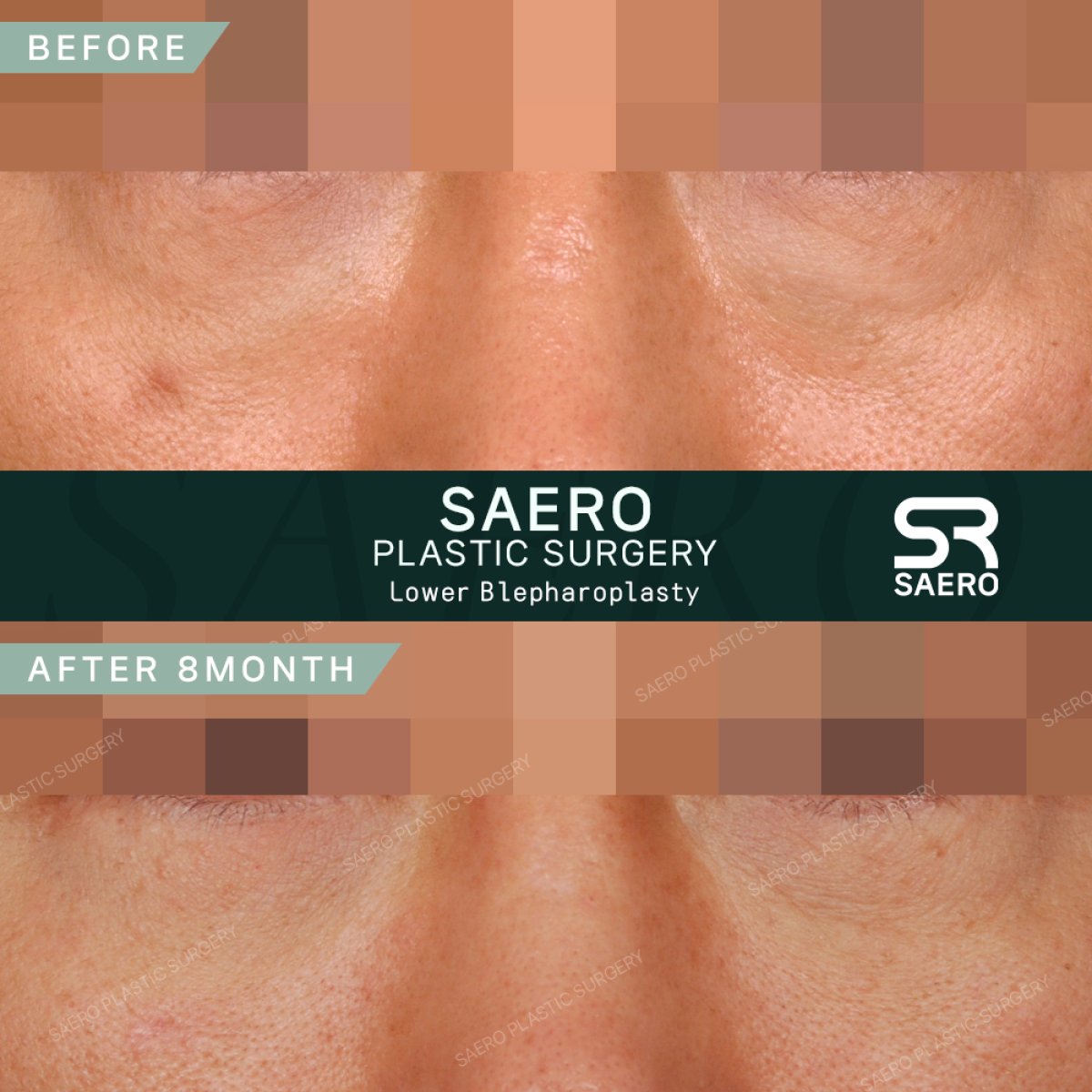 Résultats avant/après blépharoplastie inférieure chez SAERO Plastic Surgery, 8 mois