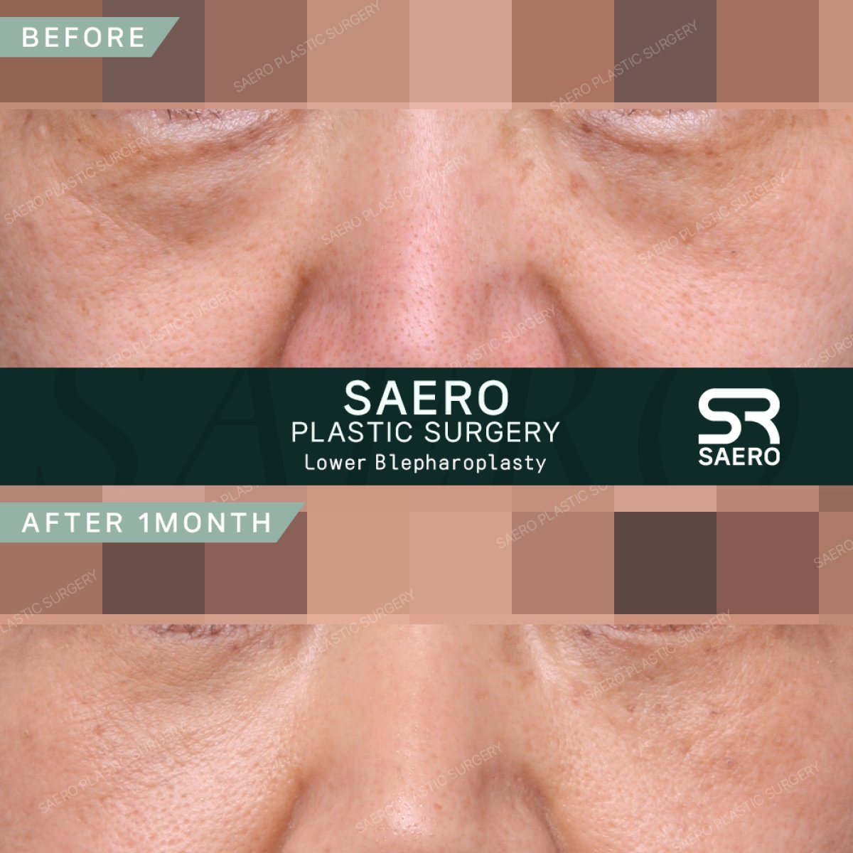 نتائج رأب الجفن السفلي قبل وبعد في SAERO Plastic Surgery بعد شهر واحد