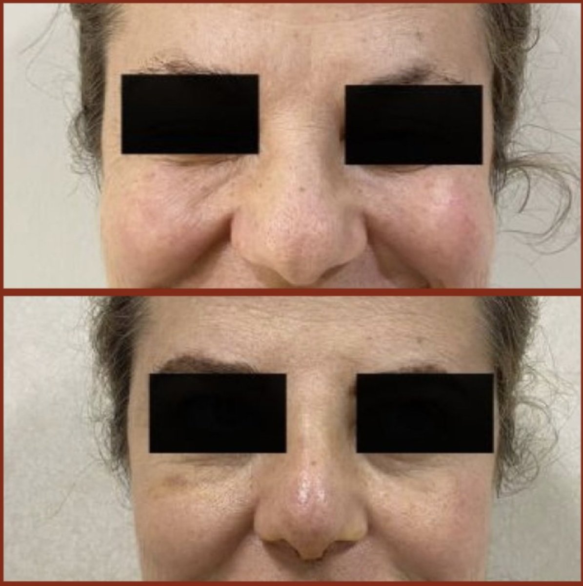 Resultados de rinoplastia antes y después en DGB Clinic, mejor forma nasal y simetría facial