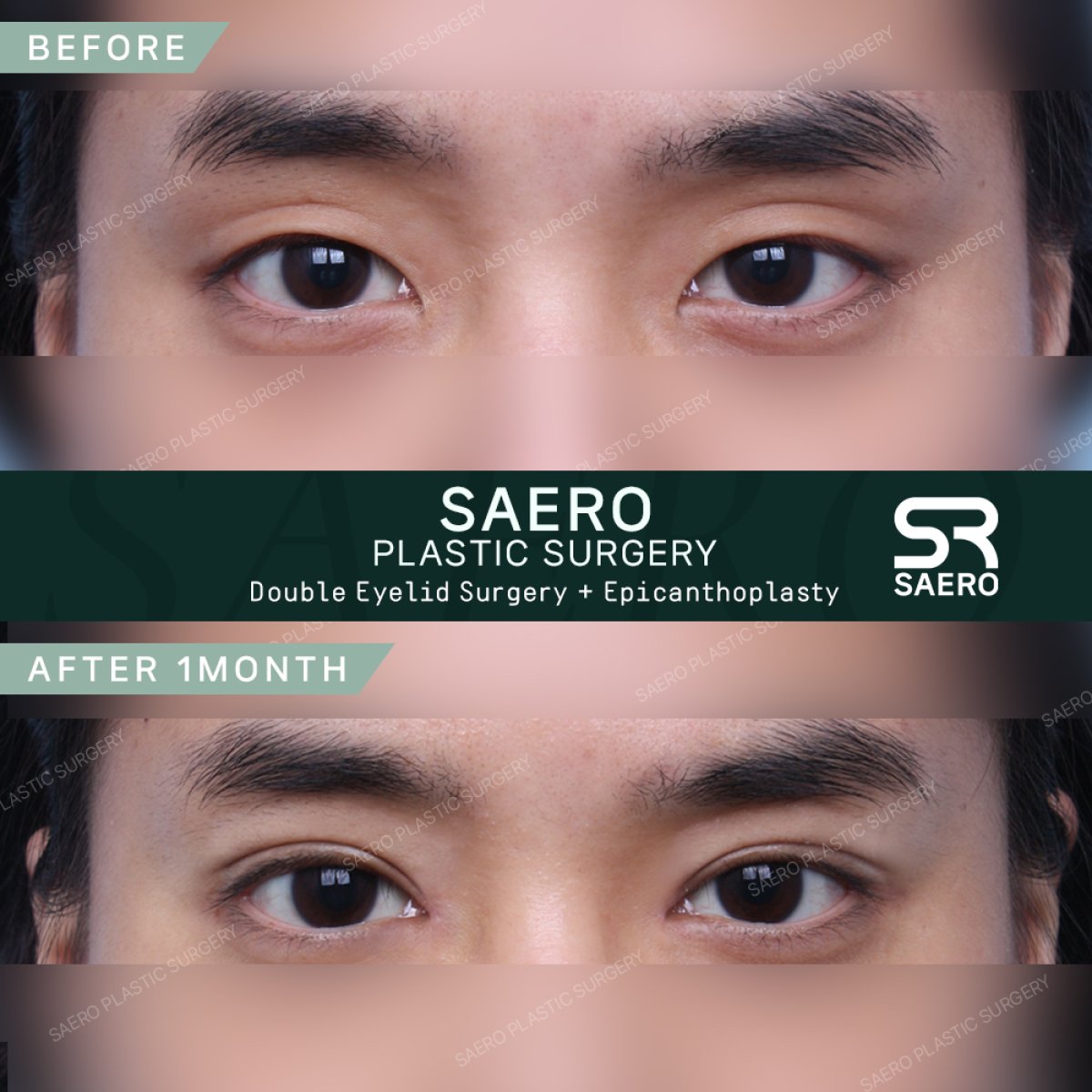 Результати до і після операції на опущених повіках у SAERO Plastic Surgery, покращення очей