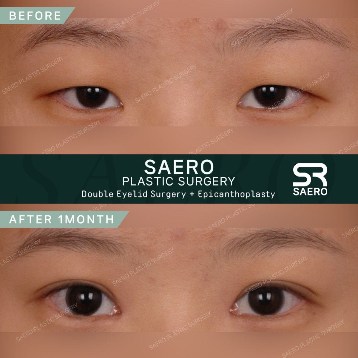نتائج قبل وبعد جراحة الجفن المتدلي في SAERO Plastic Surgery، تحسين شكل الجفن