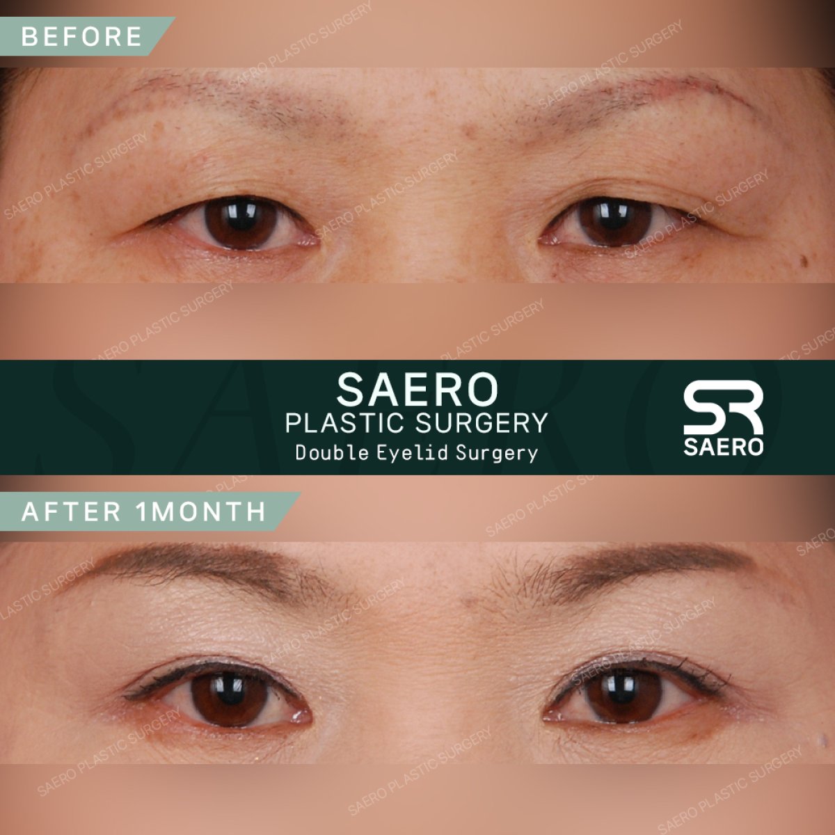 Before and after droopy eyelid surgery results at SAERO Plastic Surgery, improved eyelid contour