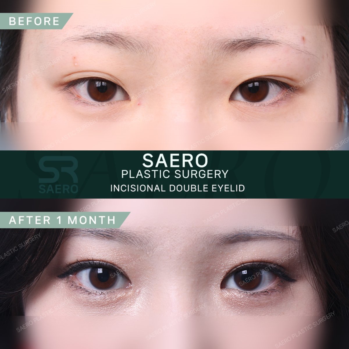 نتائج قبل وبعد جراحة الجفن المتدلي في SAERO Plastic Surgery، مظهر عين محسّن