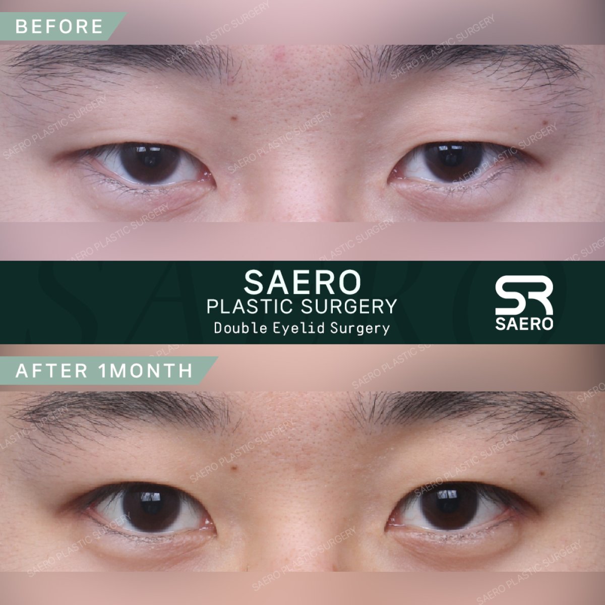 نتائج قبل وبعد جراحة الجفن المترهل في SAERO Plastic Surgery، تحسين شكل الجفن