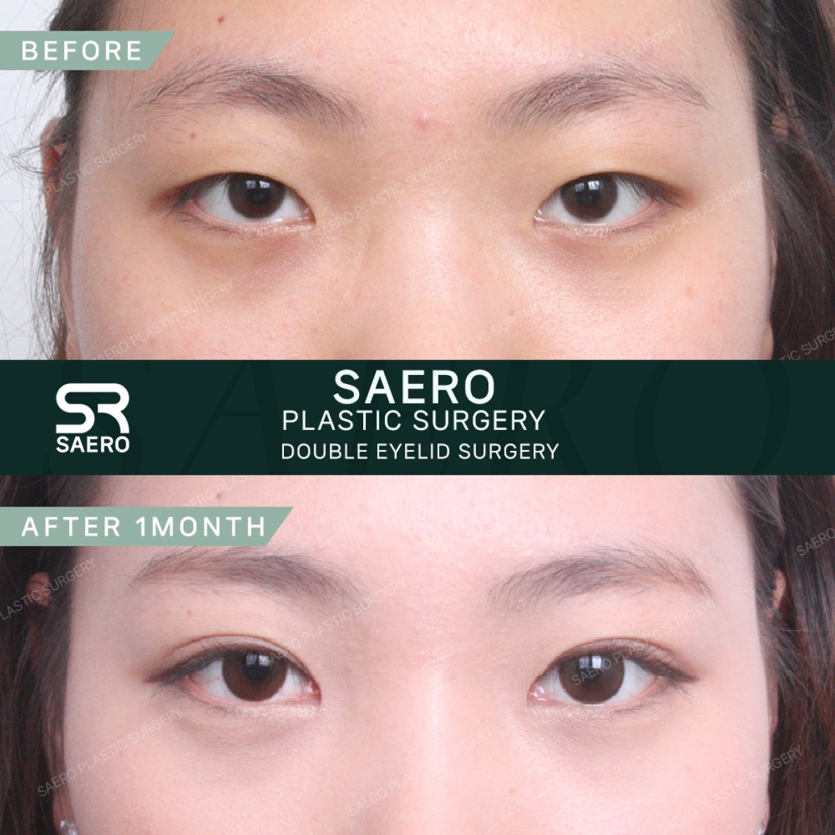نتائج قبل وبعد جراحة الجفن المزدوج في SAERO Plastic Surgery بعد شهر واحد