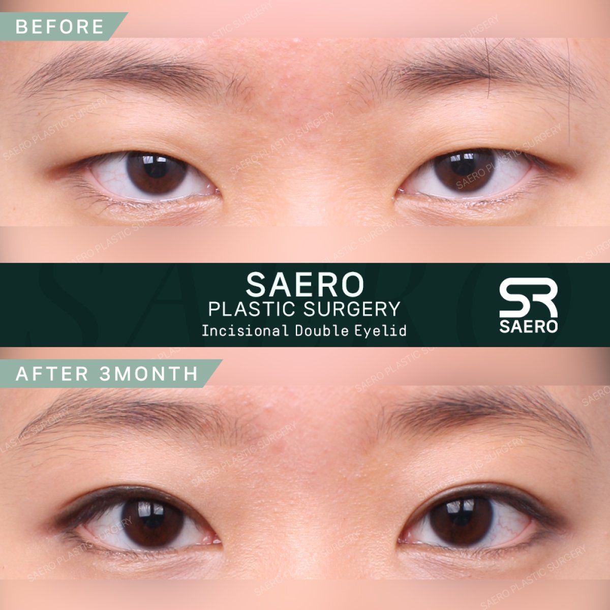 Before and after droopy eyelid surgery results at SAERO Plastic Surgery, improved eyelid contour