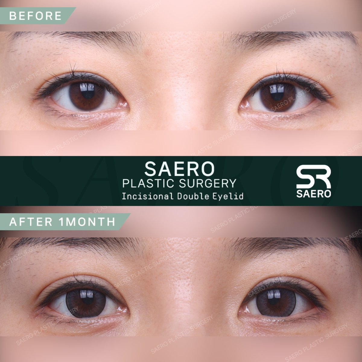 نتائج قبل وبعد جراحة الجفن المتدلي في SAERO Plastic Surgery، تحسين شكل الجفن
