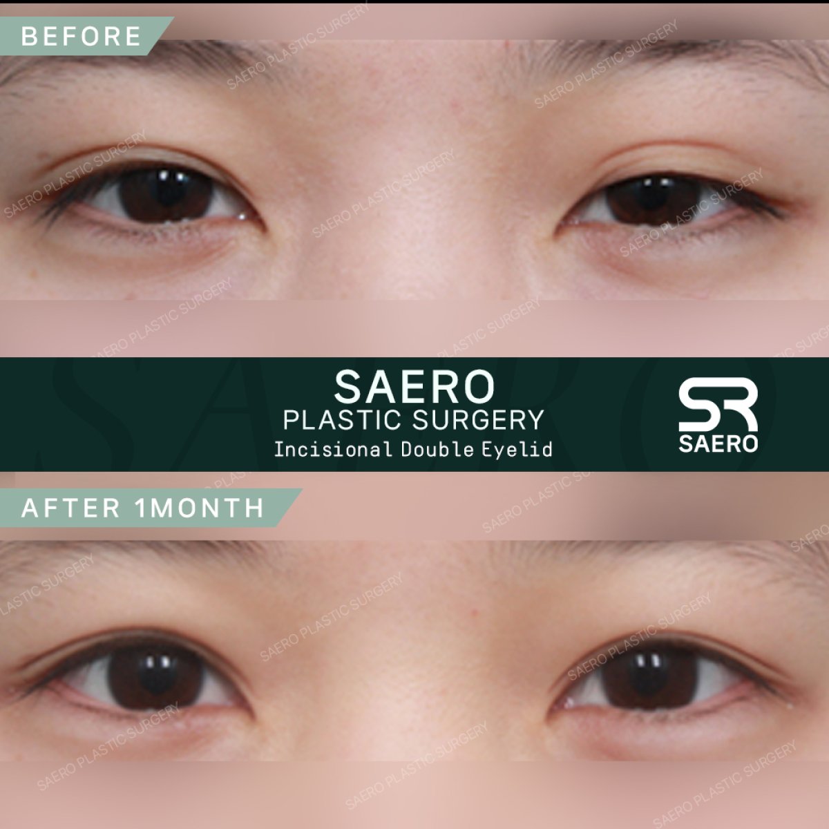 نتائج قبل وبعد جراحة الجفن المتدلي في SAERO Plastic Surgery، مظهر عين محسّن