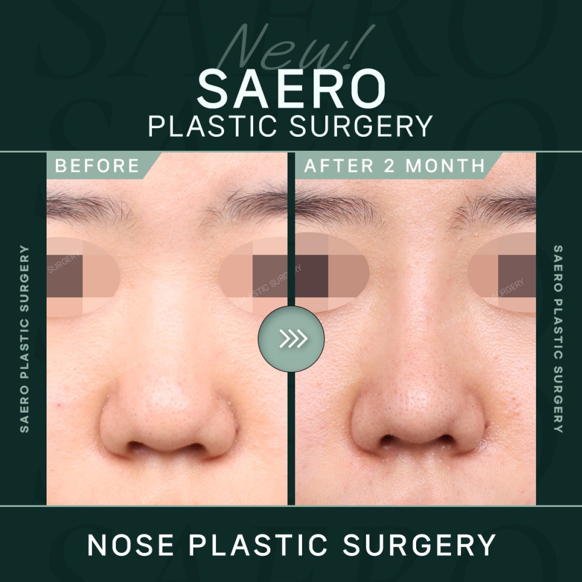 Before and after tip rhinoplasty results at SAERO Plastic Surgery, improved nose shape
