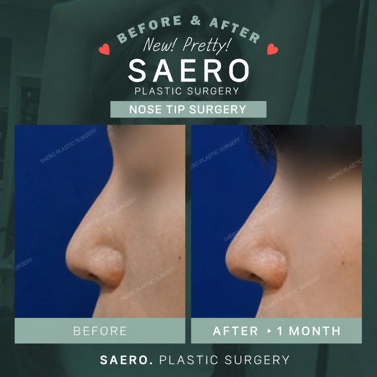 Before and after tip rhinoplasty results at SAERO Plastic Surgery, improved nose shape