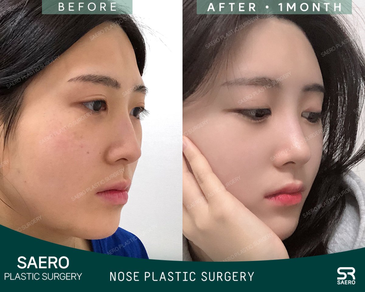 نتائج قبل وبعد تجميل طرف الأنف في SAERO Plastic Surgery، تحسين شكل الأنف