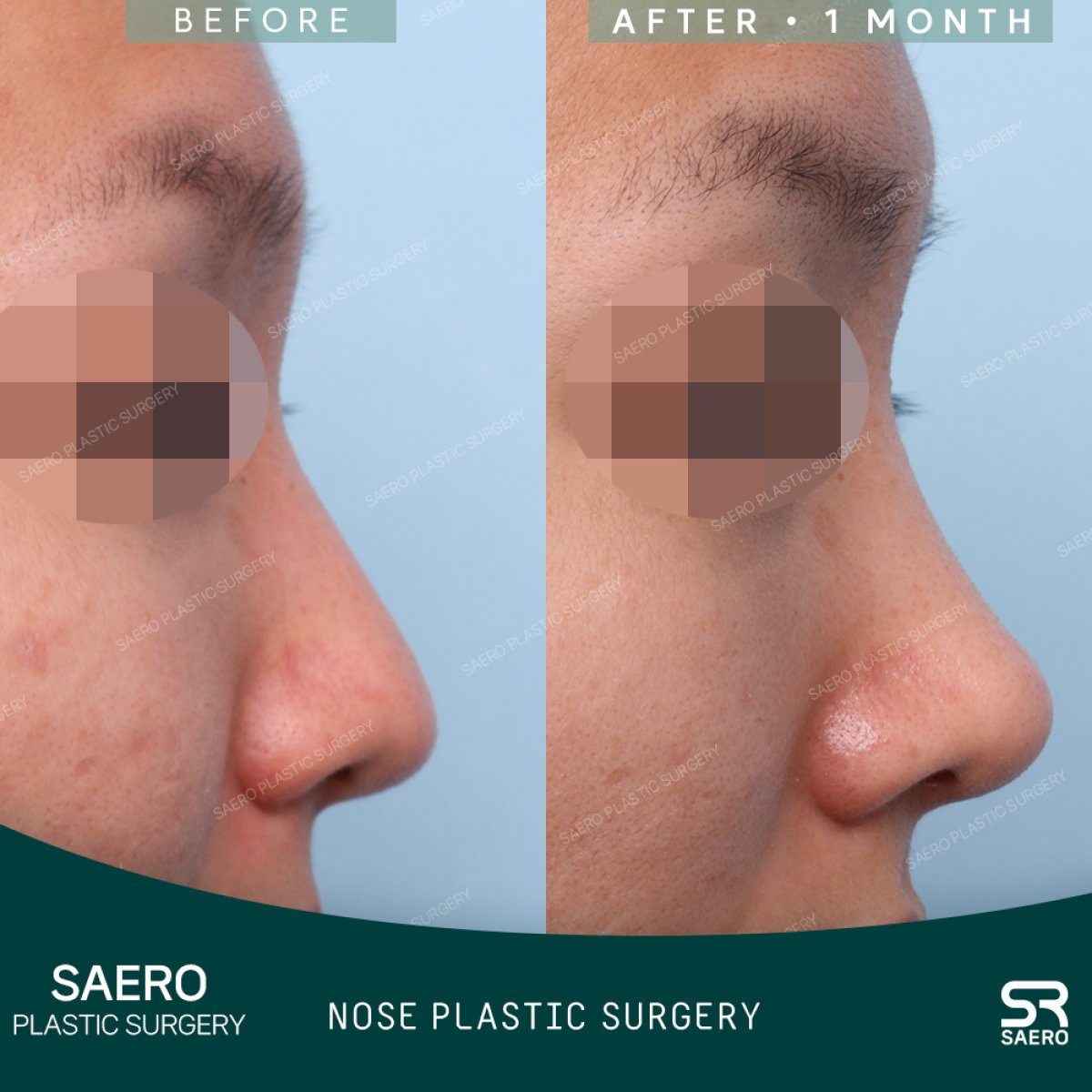Resultados antes y después de rinoplastia de punta en SAERO Plastic Surgery, contorno mejorado