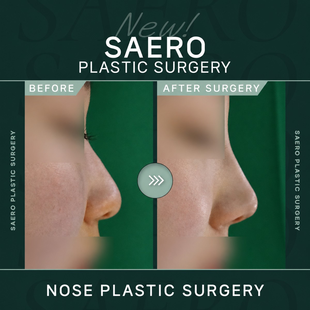 Before and after closed rhinoplasty results at SAERO Plastic Surgery, improved nose profile