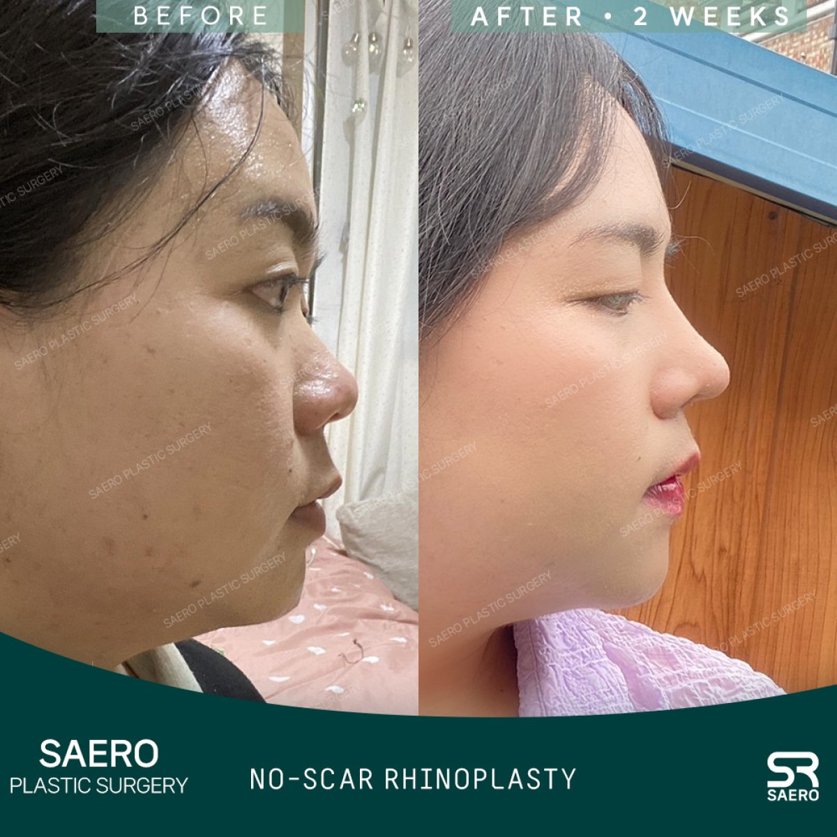 نتائج قبل وبعد عملية تجميل الأنف المغلقة في SAERO Plastic Surgery، إعادة تشكيل الأنف بدون ندوب